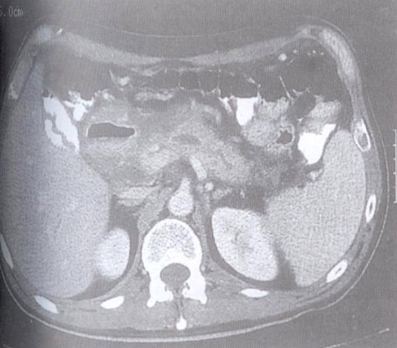 南微医学：胰腺囊肿支架去年下半年已取得国内注册证，将在中国市场快速推广